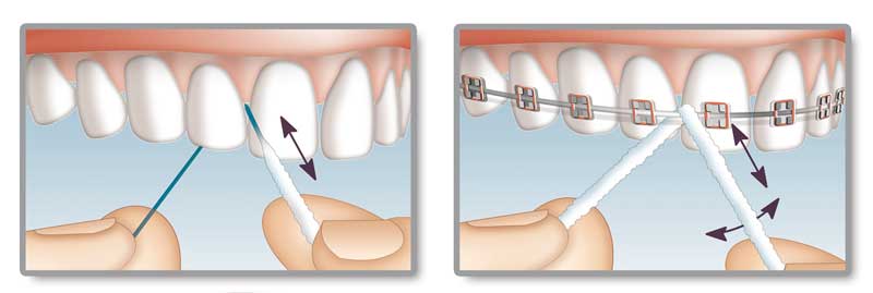 Miradent Mirafloss Implant - zubní nit pro implantáty - obrázek 3